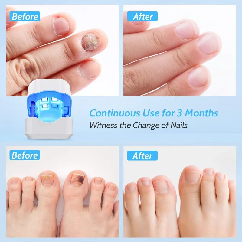 Fungi Cure For Toe Nails Maximum Strength 905nm Red Light Therapy Painless  Toe Nail Fungus Killer - Walmart.com